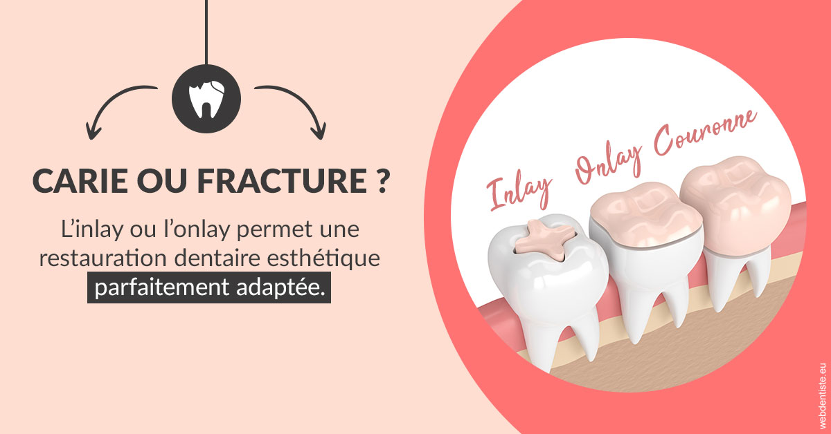 https://dr-hulot-jean.chirurgiens-dentistes.fr/T2 2023 - Carie ou fracture 2