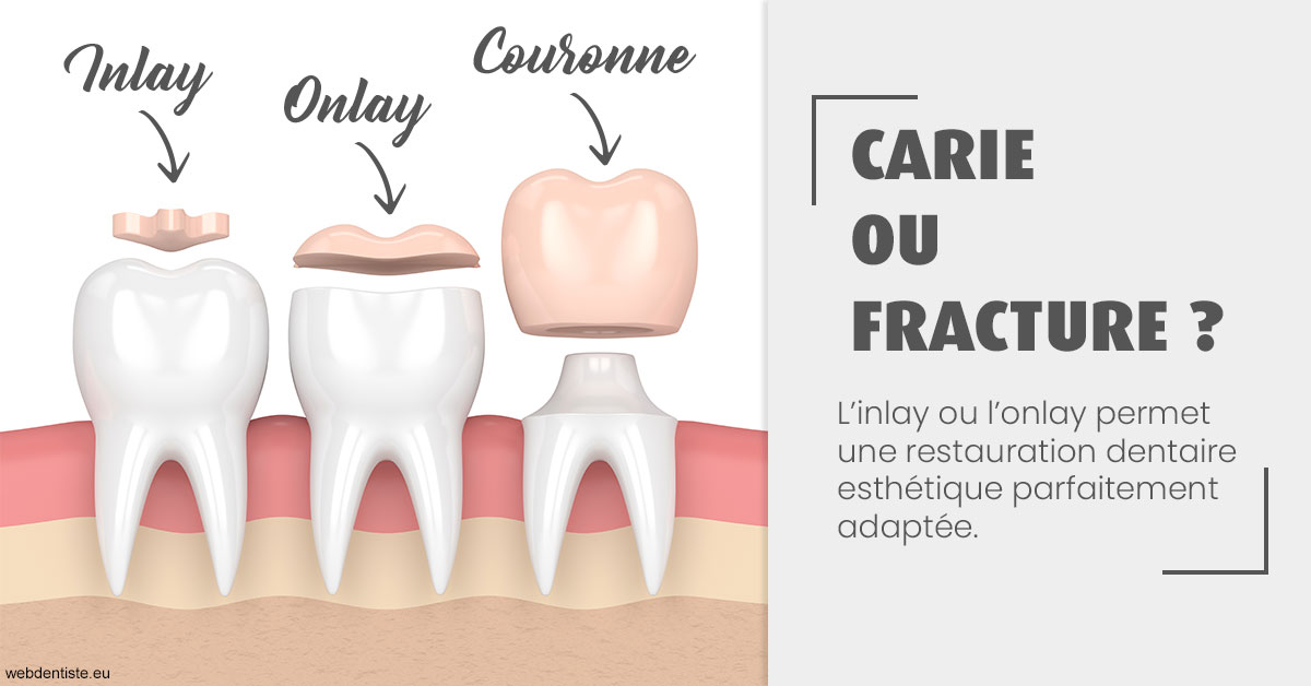 https://dr-hulot-jean.chirurgiens-dentistes.fr/T2 2023 - Carie ou fracture 1