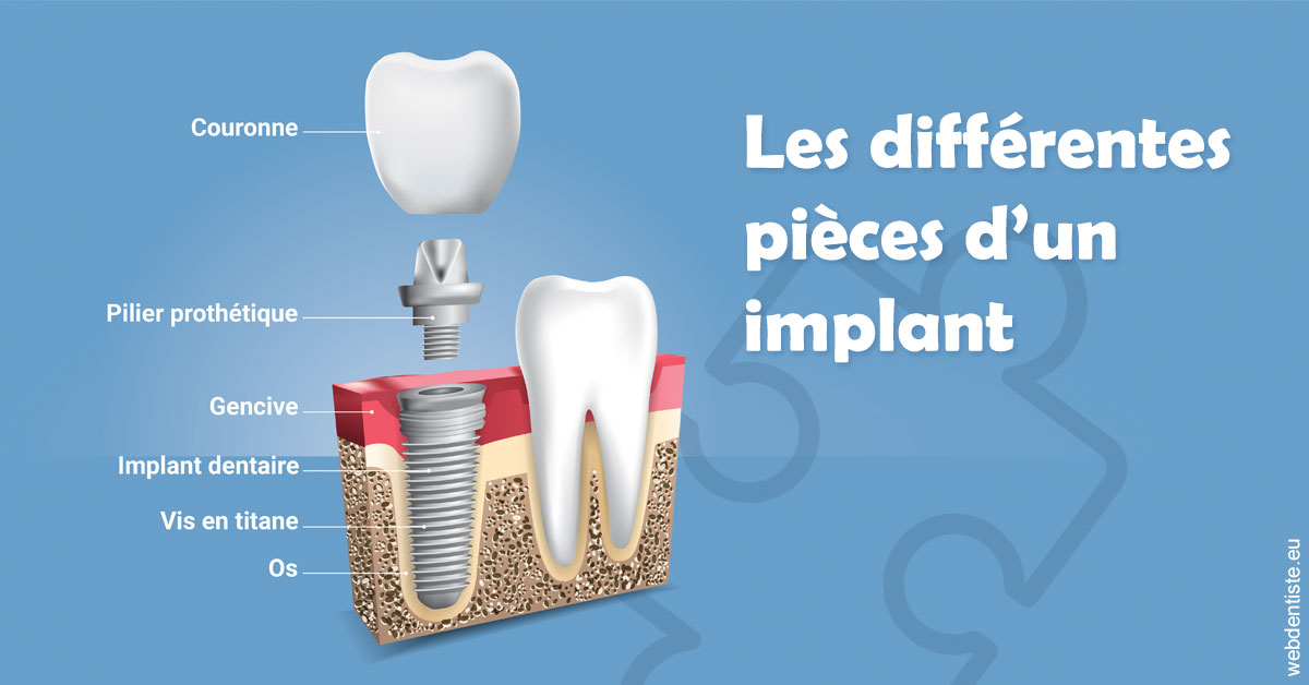 https://dr-hulot-jean.chirurgiens-dentistes.fr/Les différentes pièces d’un implant 1